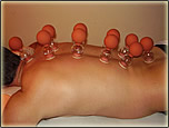 Schröpfkopfmassage